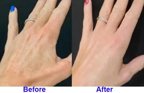 Before After Skin Resurfacing Patient