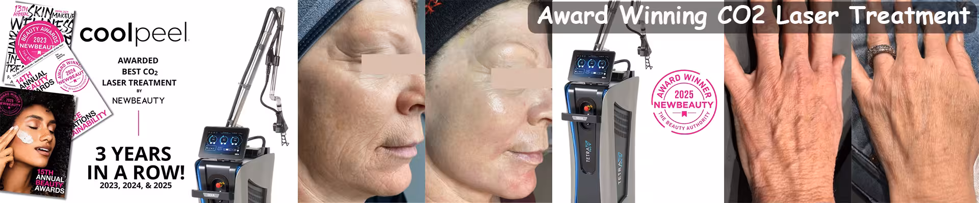 Tetra PRO CoolPeel Laser Treatment